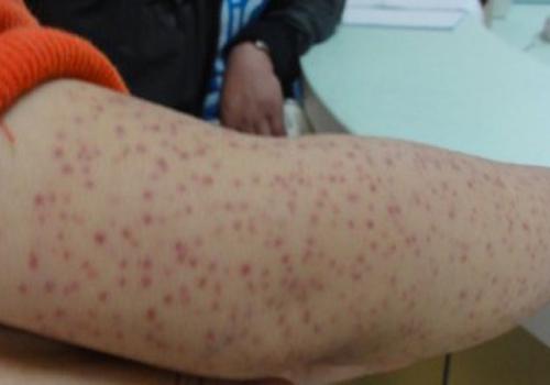 皮下出血点是什么原因（皮下出血点是什么原因造成的 治疗）