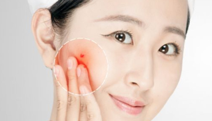 刷杏仁酸到底要不要洗掉 刷杏仁酸后需要洗掉吗