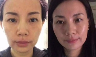 美容除皱方法 有什么实用的技巧