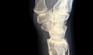 骨质疏松不能吃什么 骨质疏松的禁忌事项