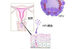 HPV是什么 只有了解其病因才能及早的预防