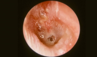 中耳炎怎么治疗 治疗的三个科学方法