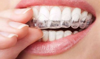 牙套适合年龄 具体是适合什么年龄