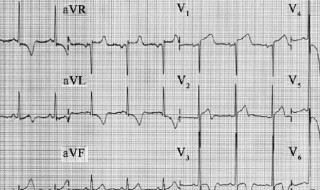 心电图st-t改变是什么意思出现 心电图st-t改变有哪些含义
