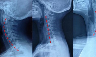 颈椎生理曲度变直是什么意思 何谓颈椎生理曲度变直