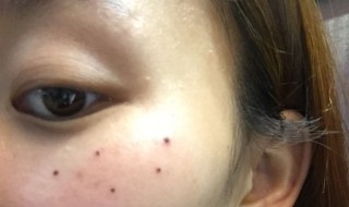 脸上的痣哪些不能点掉 脸上不能点掉痣有哪些