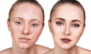 脸上长痘印怎么办 脸上痘印去不掉