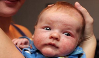 婴儿脸上长湿疹怎么治，宝妈别担心，以下妙招缓解宝宝的肌肤问题