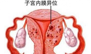 子宫内膜移位怎么办 两种治疗方式推荐