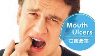 口腔溃疡怎么办 五个治疗和预防方法