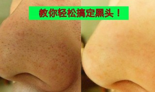 清理黑头最有效的方法 清理黑头最有效的方法介绍
