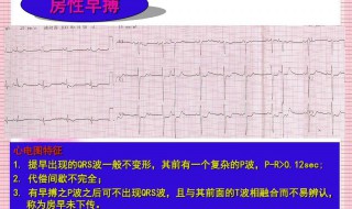 心电图ecg是什么意思 心电图ecg是何意