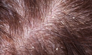 头发秃怎么办 头发秃如何办