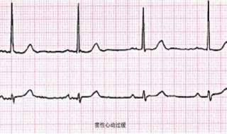 窦性心动过缓怎么办 窦性心动过缓是什么