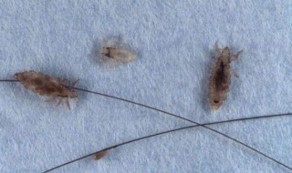 怎样快速除掉虱子 快速除掉虱子的方法