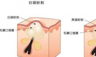 脸上粉刺闭口怎样消除 消除脸上粉刺闭口的方法