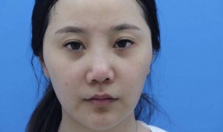 减轻泪沟的方法 减轻泪沟的方法介绍