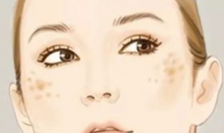 黄褐斑挂什么科 黄褐斑的临床表现