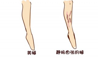 静脉曲张手术后需要多久才康复 要注意些什么