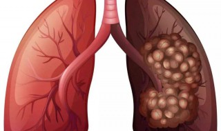 肺癌刚做完手术会转移吗 注意事项