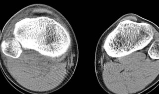 右膝镜台粉碎性骨折直骨六个月怎样康复 怎么恢复