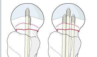 股骨颈骨折内固定术以后会坏死吗 愈合率高吗