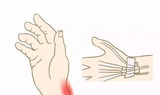 腕管综合症手术后的锻炼方法. 怎样能逐步恢复?