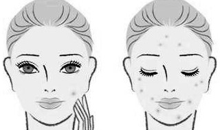 脸被风吹会长痘痘吗 答案是不会