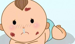 胎记怎么处理 解决胎记的妙招