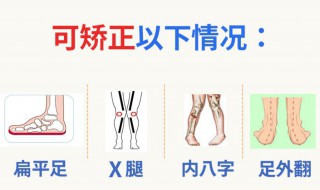 矫正内八字最快的方法 怎么矫正内八字