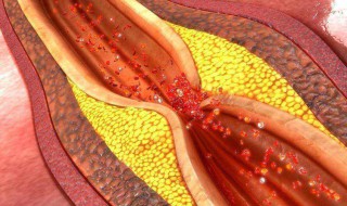 血菅堵塞多少需做支架 血塞须知