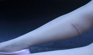 小腿碰伤肿青如何消肿 分享几种消肿的方法