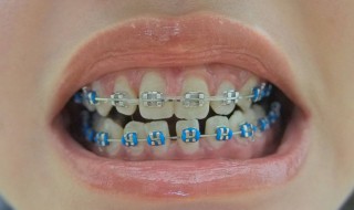 做牙套的利弊 两利两弊大揭晓