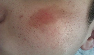 结痂掉了白印怎么消除 你知道吗