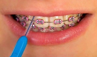戴牙套不能吃什么 戴牙套的注意事项