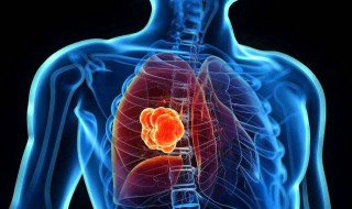 肺癌免疫疗法费用多少 你知道吗