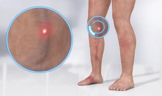 大腿静脉曲张原因 原来是这样