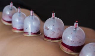 拨火罐时身上那些地方能放血 放血拔罐的注意事项