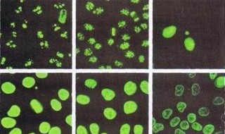 抗核抗体12项是什么 一般都是什么病