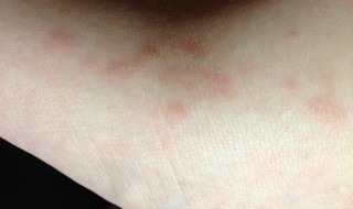 猫藓传染人什么样子 猫癣传染人的症状