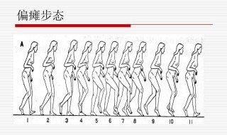 偏瘫6个月了手还不能动以后还有机会康复吗 什么是偏瘫