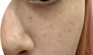 脸上为什么会长斑 脸上会长斑的原因
