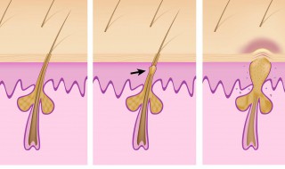 黑头粉刺清洁方法 黑头粉刺清洁方法分享