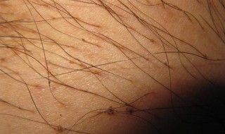 阴虱哪来的 什么是阴虱