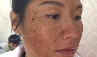 排黑色素的简单方法 排黑色素的简单方法是什么