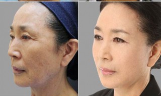 去面部皱纹方法 面部去皱纹的方法