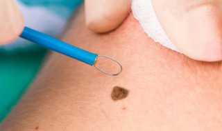 食禄痣是什么意思 食禄痣的意思是什么