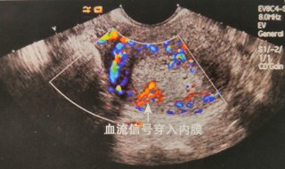 血流信号是什么意思 血流信号的意思