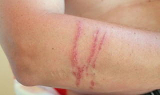 怎么去疤 怎样去疤