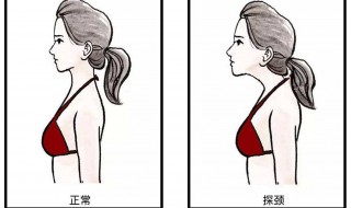 脖子向前伸怎么矫正 坚持就是胜利